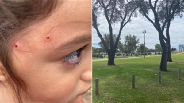 الطفلة بعد إصابتها