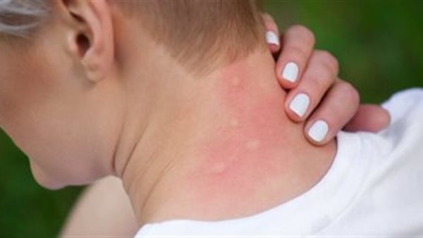 لدغات البعوض