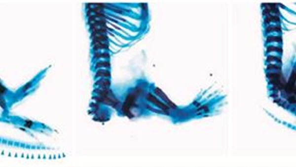 متلازمة زكي 