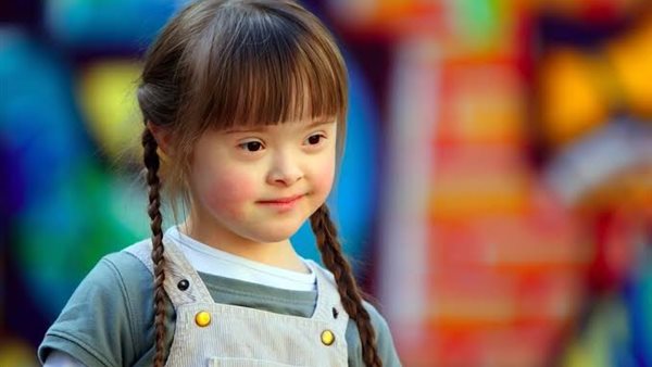 متلازمة داون 