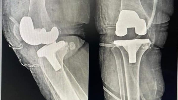 تركيب مفصل صناعي