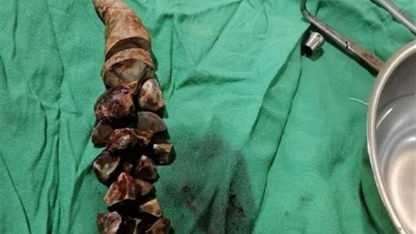 استخراج 37 حصوة من