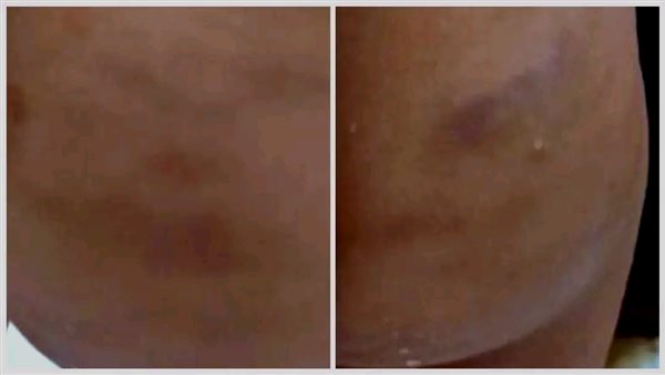 تعذيب الأطفال 