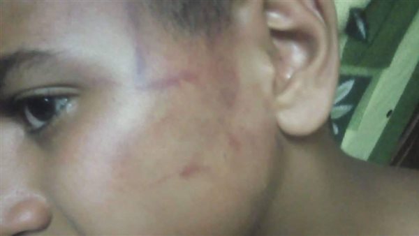 الطفل المصاب