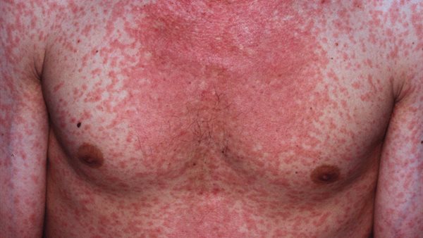 مرض الحصبة الألمانية