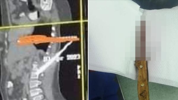 السكينة بعد استخراجها