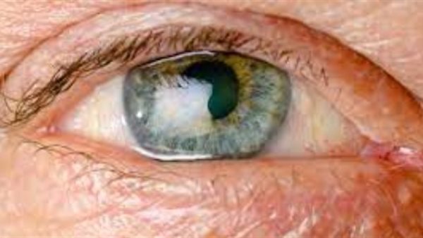 مرض ويلسون - ارشيفية