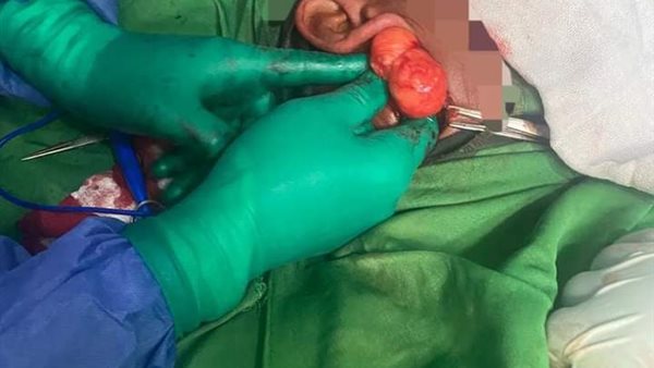 استئصال ورم علي يد