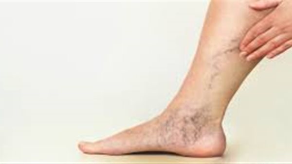 دوالي الساقين 