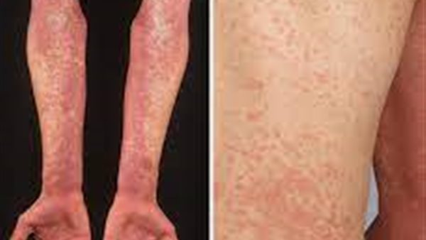 الحمى القرمزية