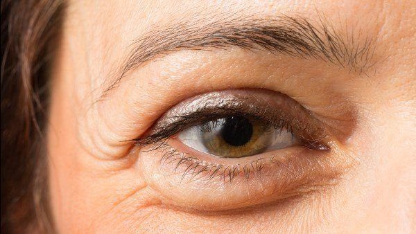 الجفون المتدلية 