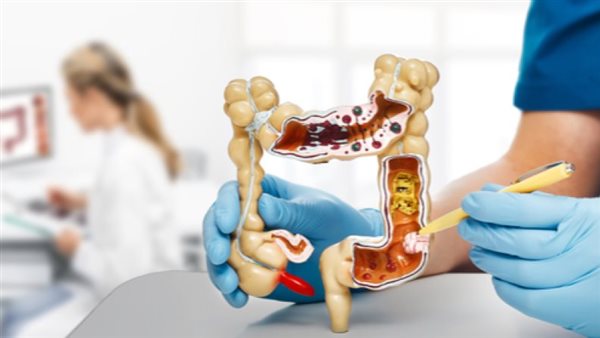 القولون - أرشيفية