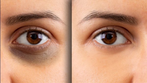 الهالات السوداء