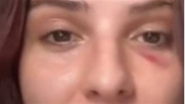 البلوجر كيت بعد التعدى