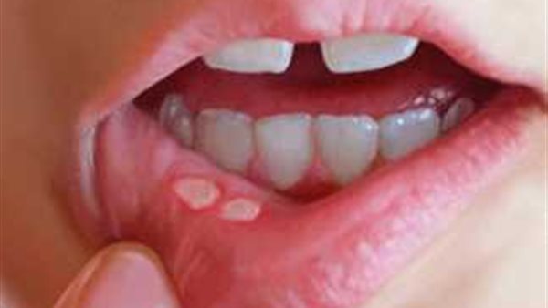 أعراض الهربس 