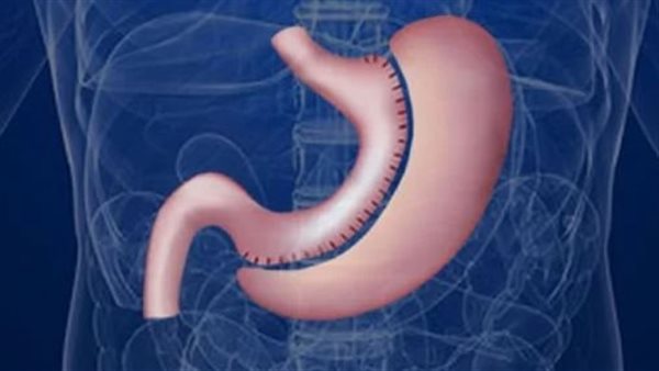 جراحات السمنه