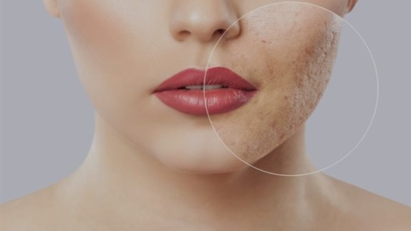 علاج ندبات الوجة