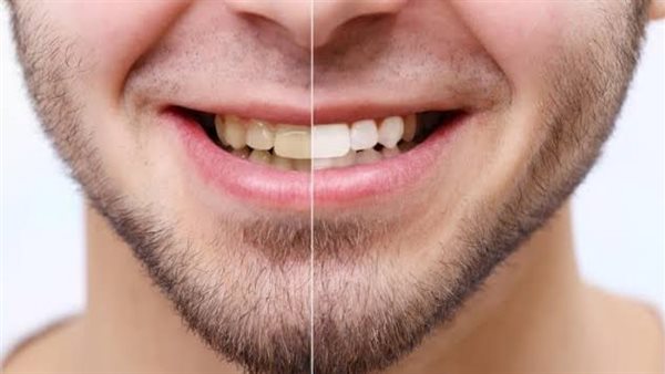 تبيض الاسنان 