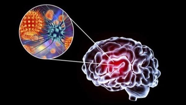 مرض التهاب الدماغ