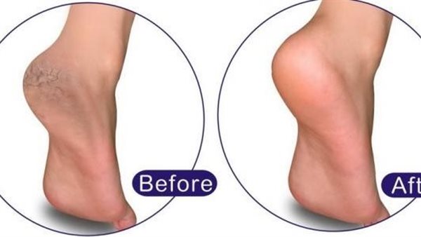 العناية بالقدمين