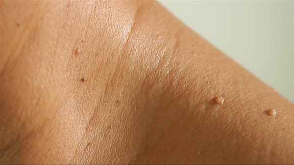 زوائد جلدية