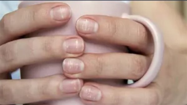 بياض الأظافر 