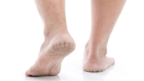 تشققات القدم 