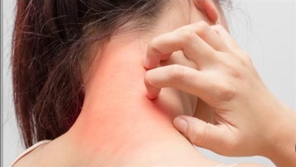 تهيج البشرة 