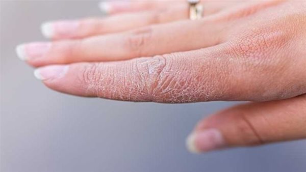 خشونة اليدين