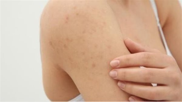 الحبوب تحت الجلد