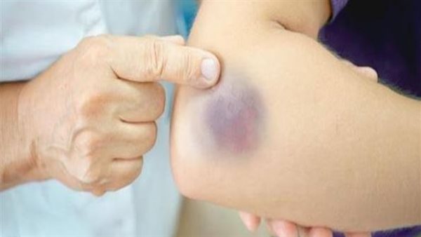 البقع الزرقاء في