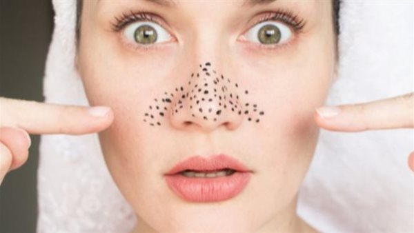 البثور السوداء