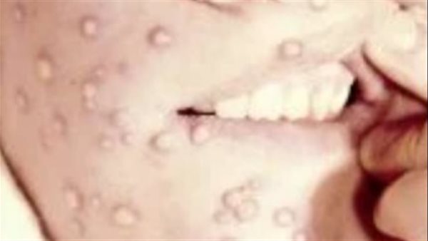 جدري القرود