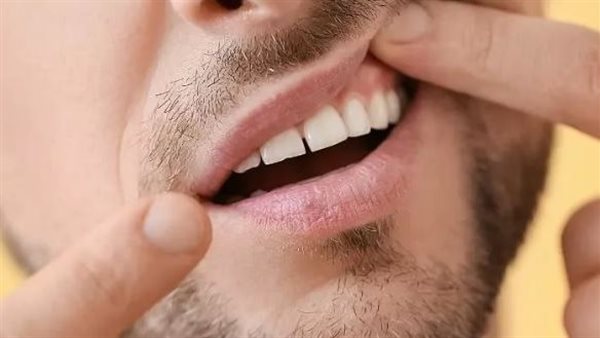 اعراض التهاب اللثة