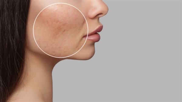 المسامات الواسعة