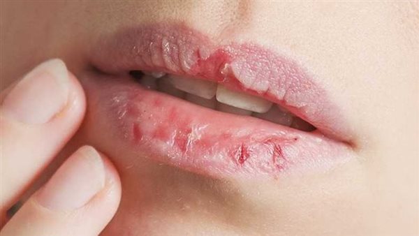 تشقق الشفاه 