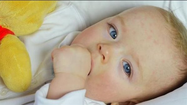 حساسية الأطفال  