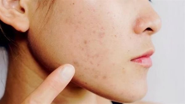 آثار حبوب الوجه