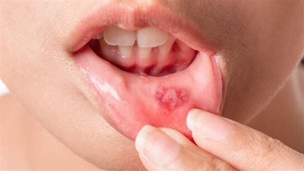 تقرحات الفم 
