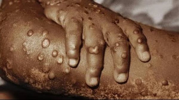 جدري القرود