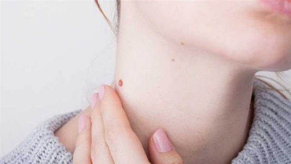 الزوائد الجلدية 