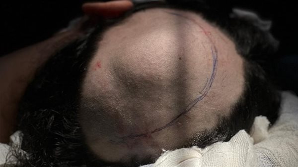 أثناء إجراء العملية