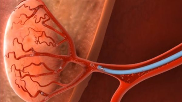 الورم الرحمي