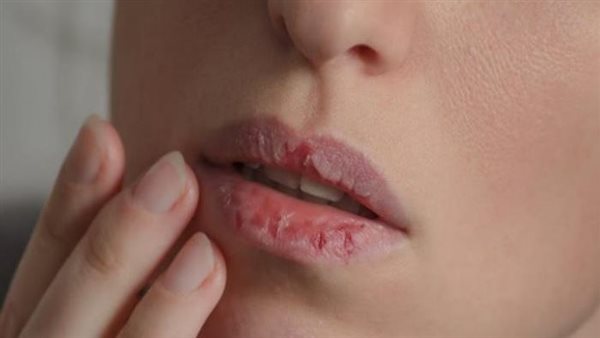 تشقق الشفاه في فصل