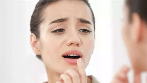 قرح البرد على الشفاه