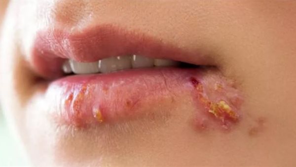 ما هو الهربس الفموي