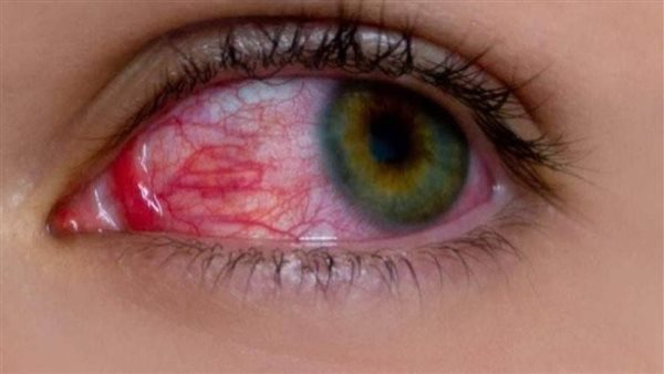 احمرار العين 