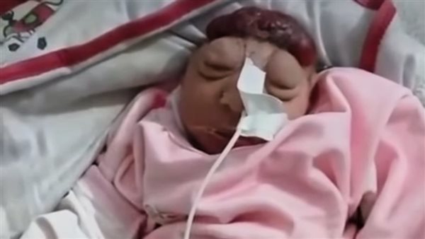 ولادة طفل بدون رأس