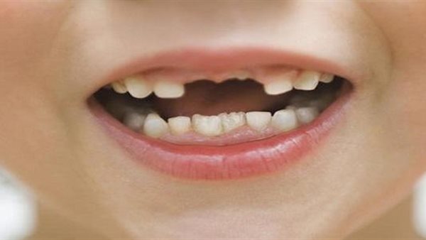 تفسير حلم وقوع الاسنان