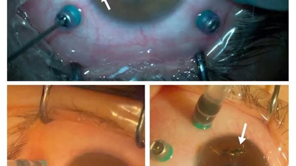 فريق قسم العيون بمستشفي